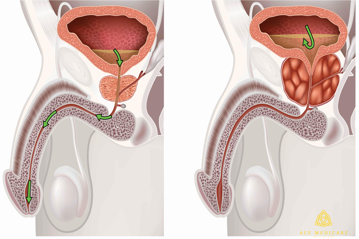 An In-Depth Look at Enlarged Prostate Treatment Options: Everything You Need to Know